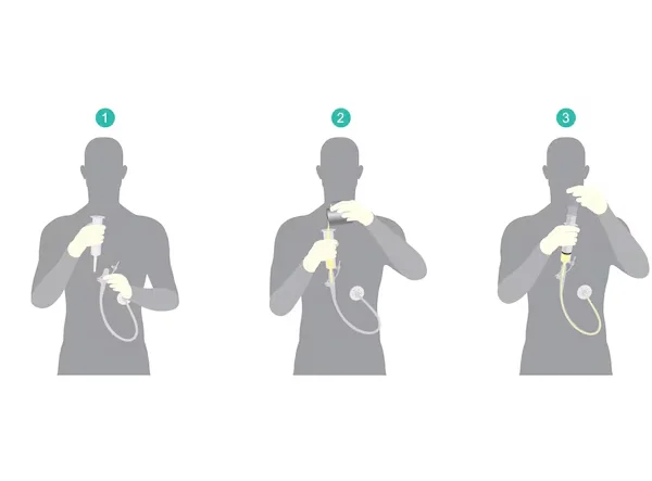 Feeding Endoscopic Gastrostomy