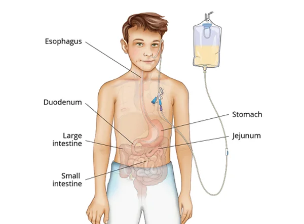 Jejunal Tube Placement